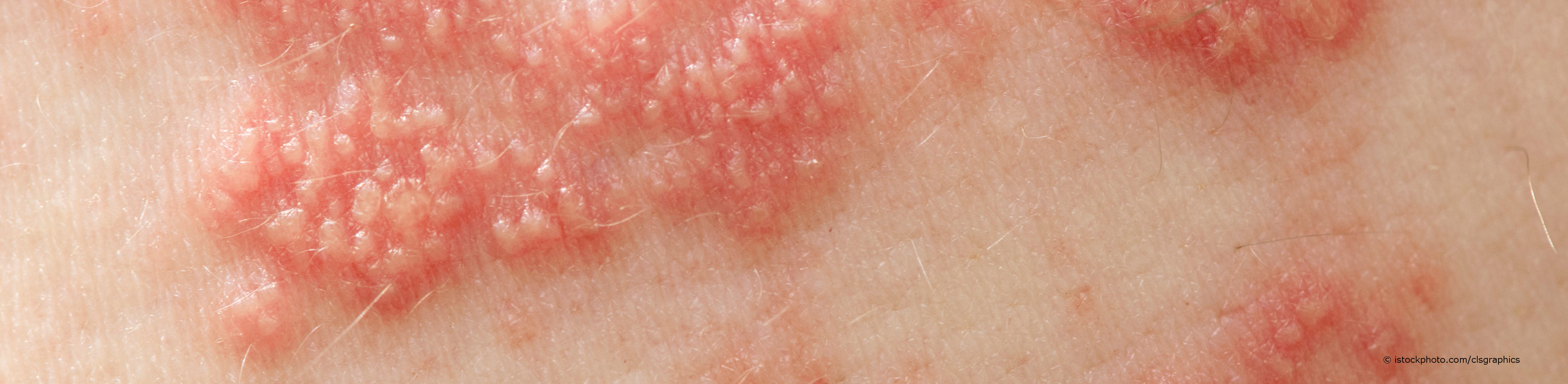 Gürtelrose (Herpes zoster) ist ein halbseitiger, gürtelähnlicher, stark schmerzender Hautausschlag.