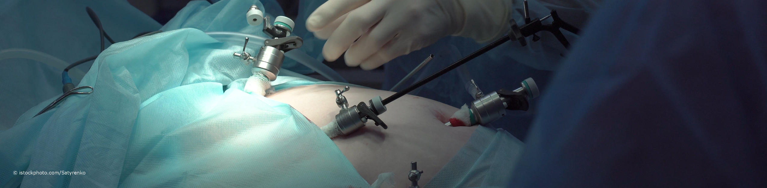 Arzt für Viszeralchirurgie schiebt bei der Bauchspiegelung ein Laparoskop durch einen Trokar in den durch eingeleitetes Gas aufgeblähten Bauch des Patienten.